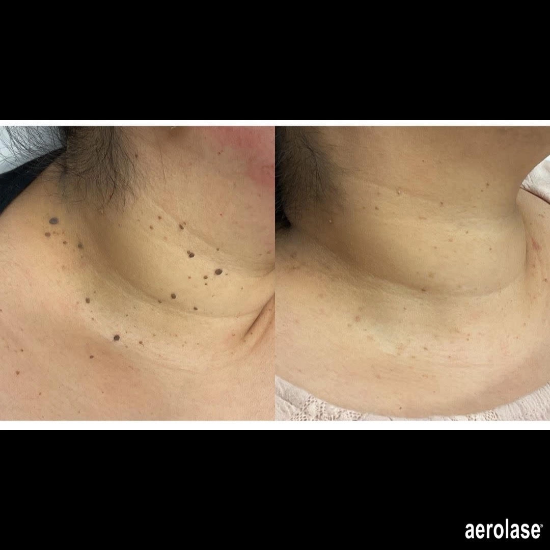 Before and after Skin tags in-murrells-inlet-sc