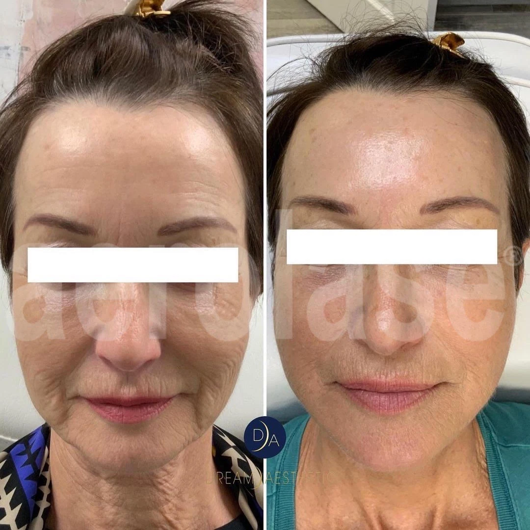 Before and after Tightening and collagen building on face and neck -in-murrells-inlet-sc