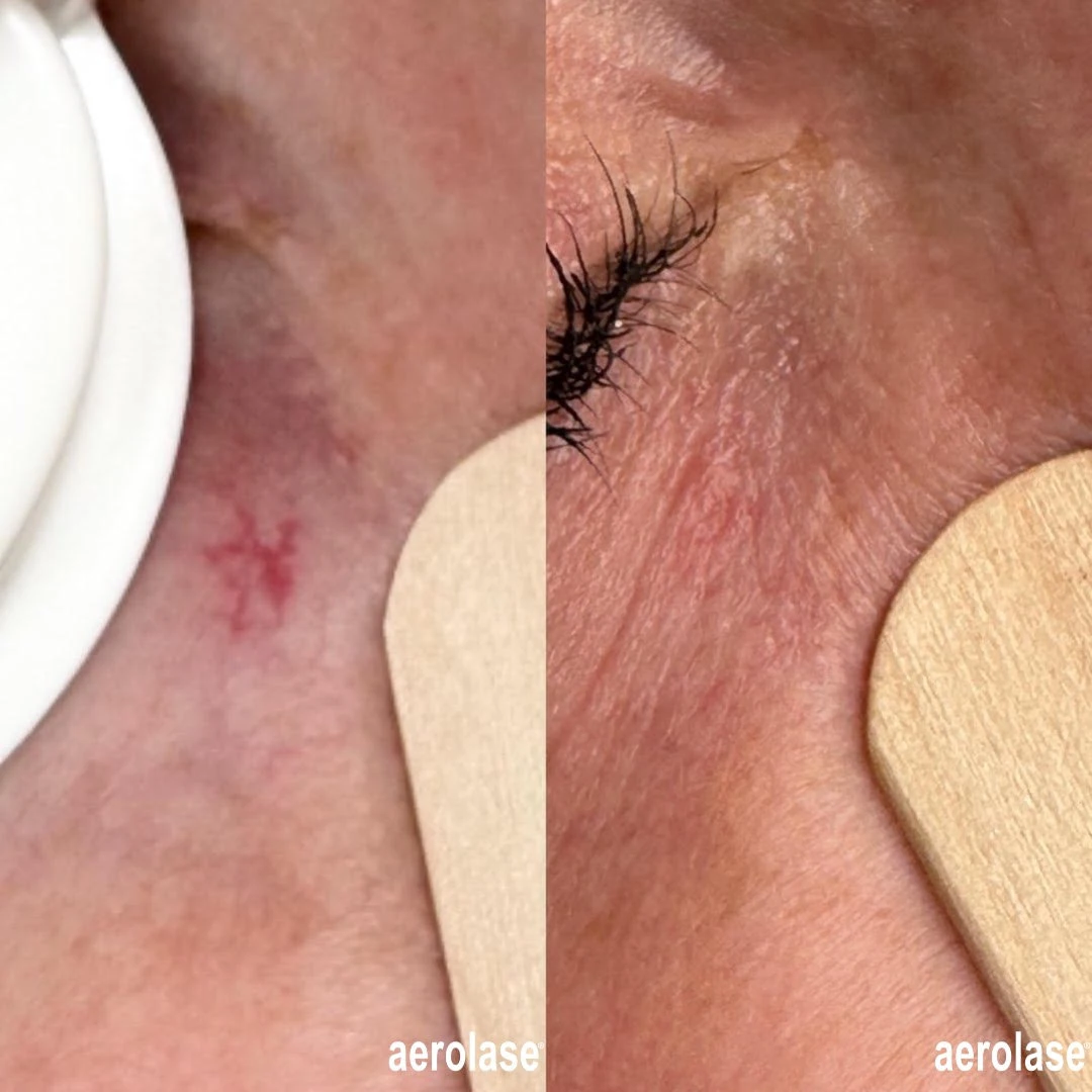 Before and after broken capillaries in-murrells-inlet-sc