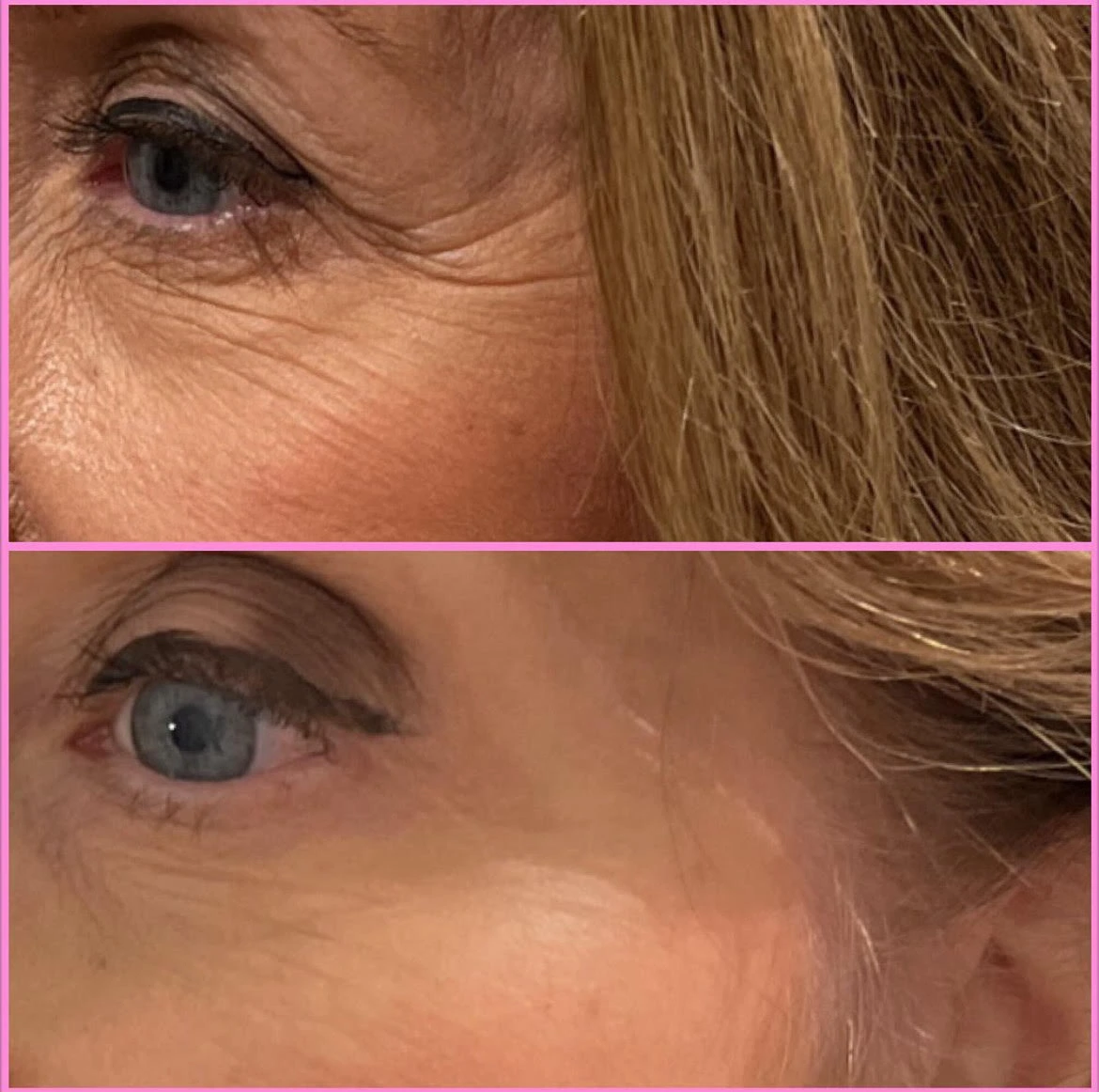 Crows Feet Before After in Murrells Inlet, SC | Posh Aesthetics