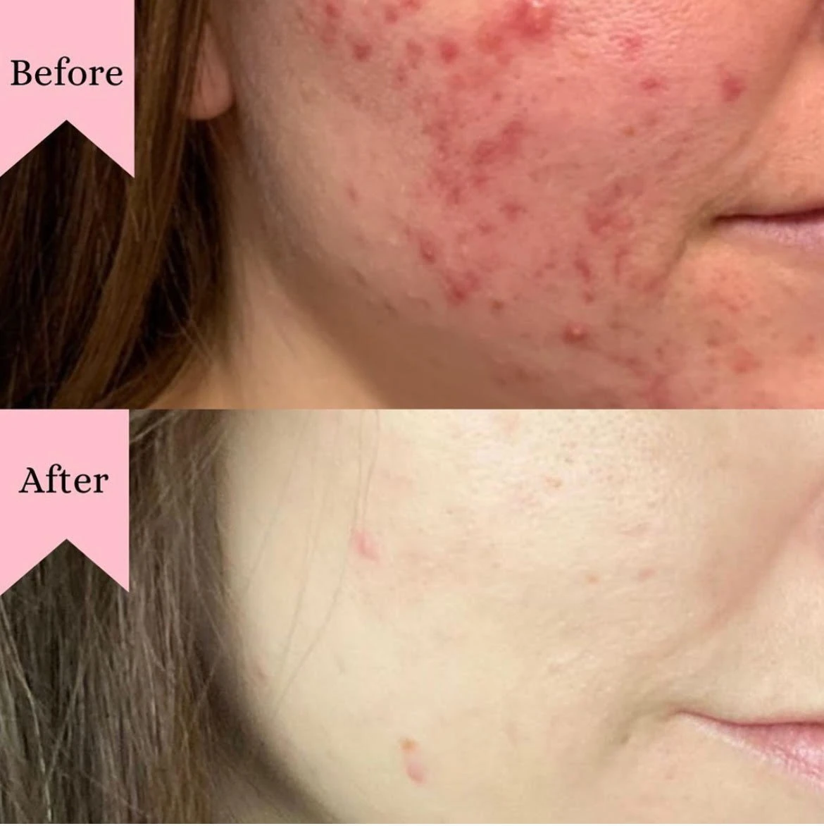 Acne Bootcamp Before After4 in Murrells Inlet, SC | Posh Aesthetics