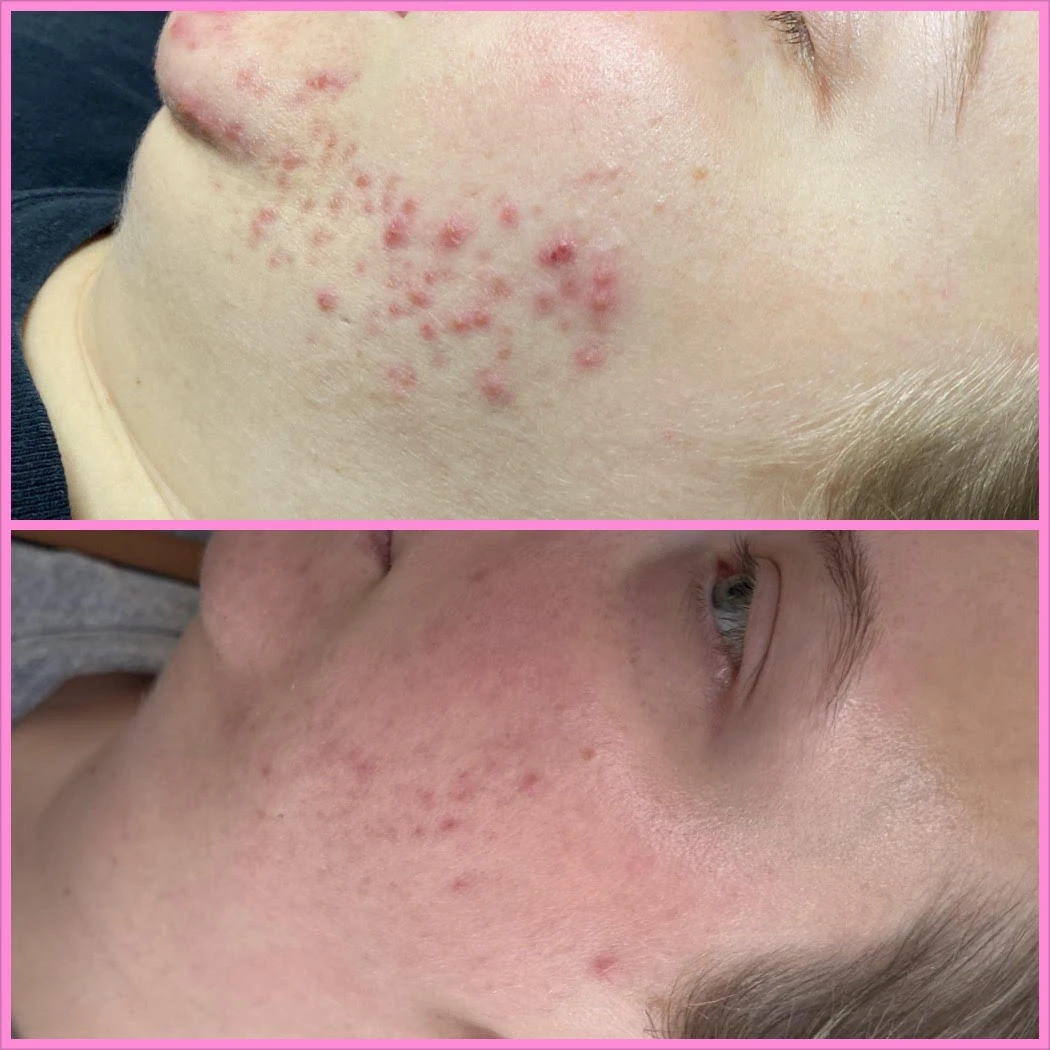 Acne Bootcamp Before After6 in Murrells Inlet, SC | Posh Aesthetics