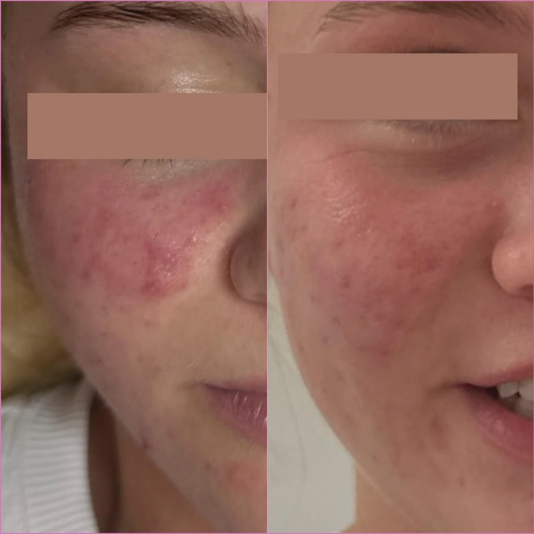 Chemical Peels Before After2 in Murrells Inlet, SC | Posh Aesthetics