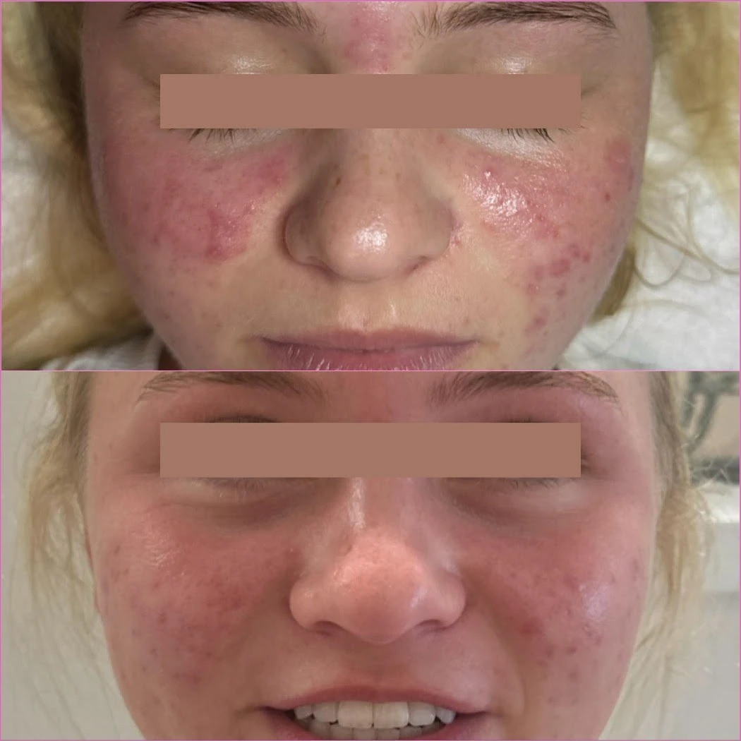 Acne Bootcamp Before After in Murrells Inlet, SC | Posh Aesthetics