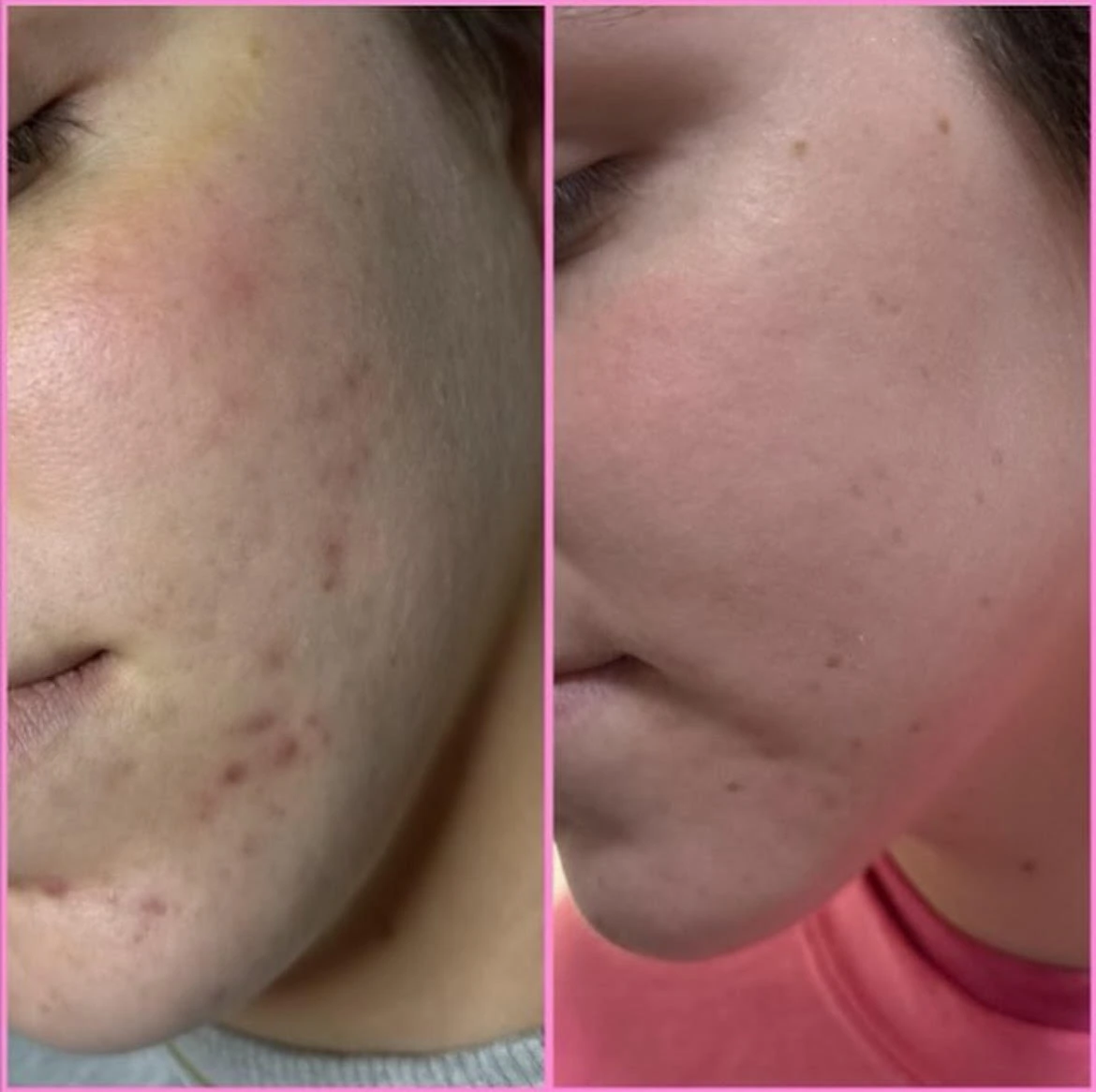 Chemical Peels Before After3 in Murrells Inlet, SC | Posh Aesthetics