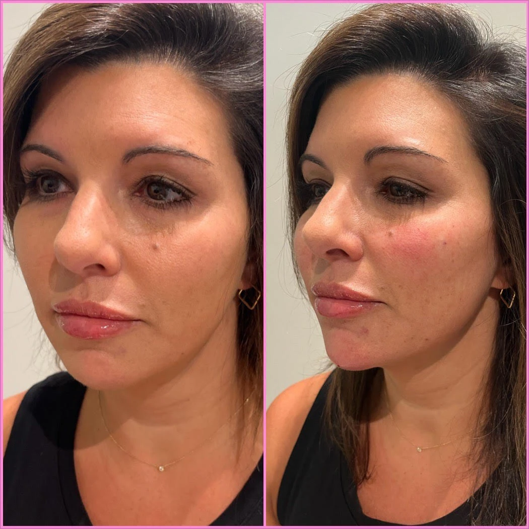 Cheek and Chin Before After in Murrells Inlet, SC | Posh Aesthetics