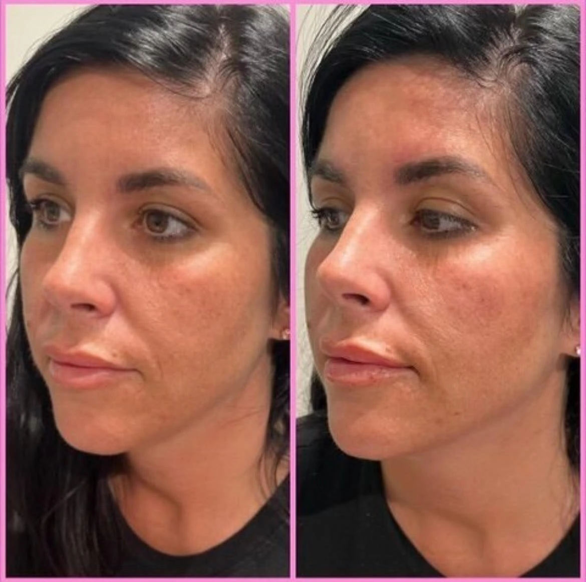 Cheeks and Chin Before After in Murrells Inlet, SC | Posh Aesthetics