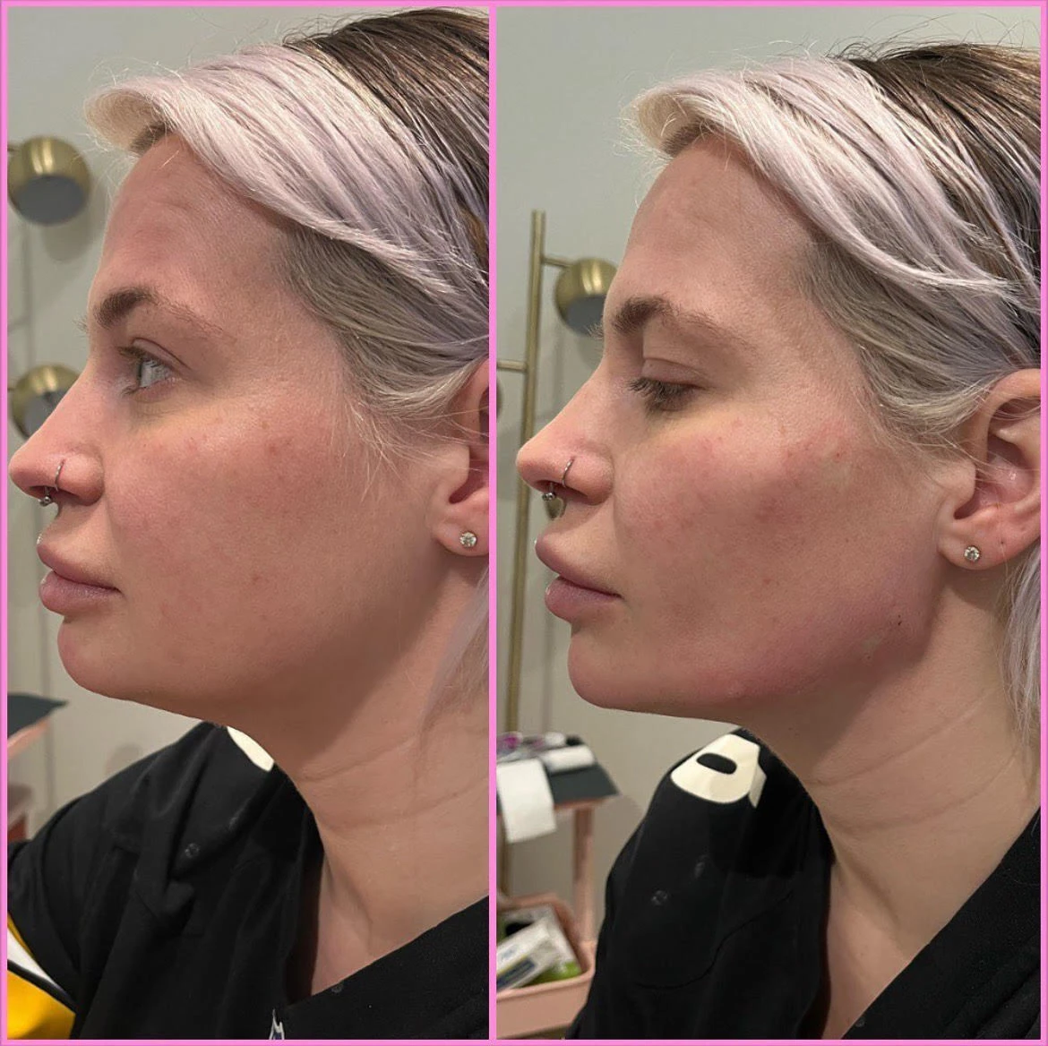 Cheeks, Jaw, Chin Before After in Murrells Inlet, SC | Posh Aesthetics