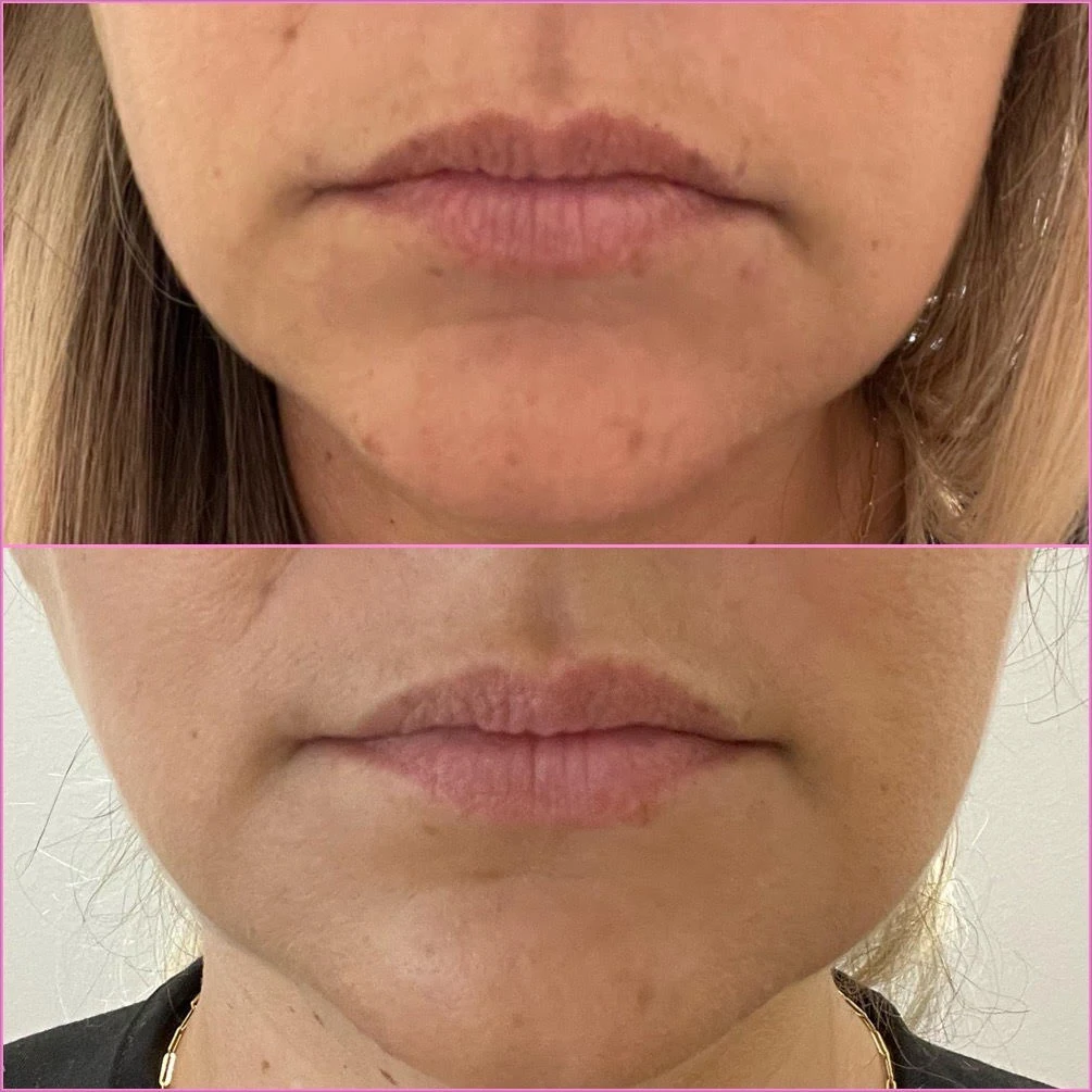 corners of mouth tox before after in-murrells-inlet-sc