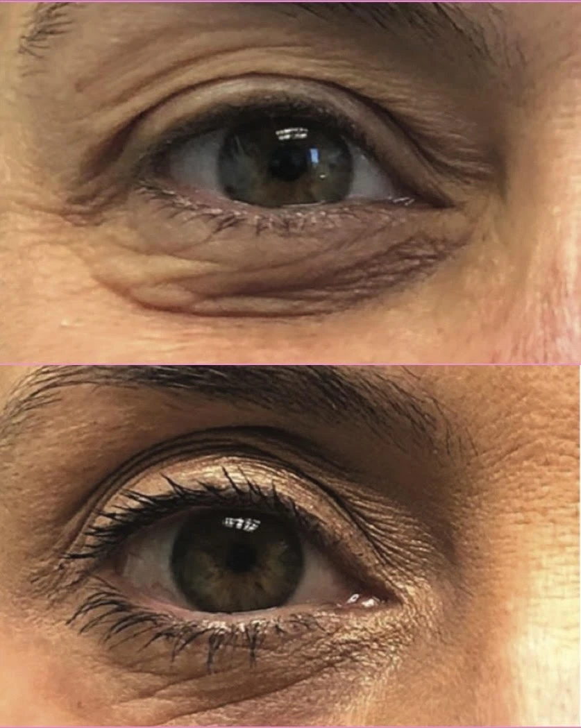 epper and lower eyelids before after in-murrells-inlet-sc