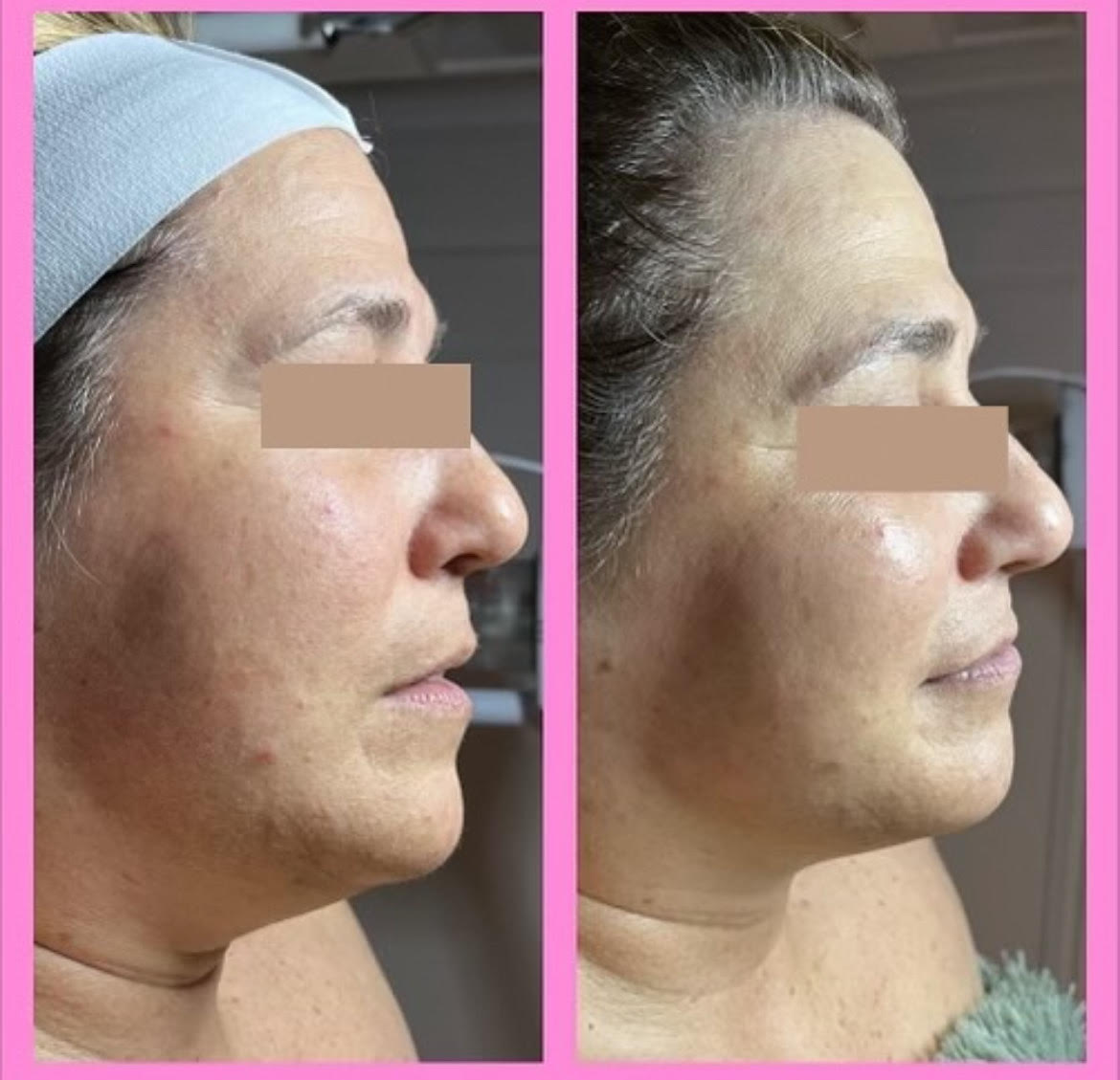 Facial Treatment Before After in Murrells Inlet, SC | Posh Aesthetics