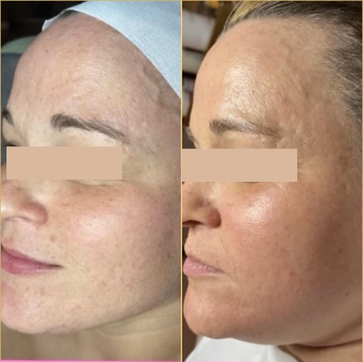 Facial Treatment Before After2 in Murrells Inlet, SC | Posh Aesthetics