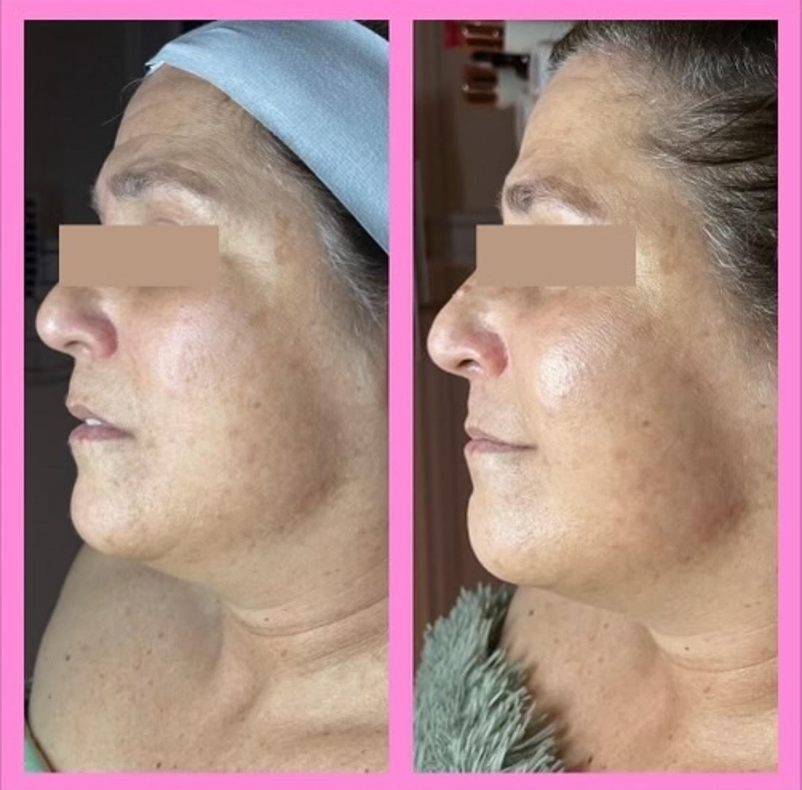 Facial Treatments Before After1 in Murrells Inlet, SC | Posh Aesthetics