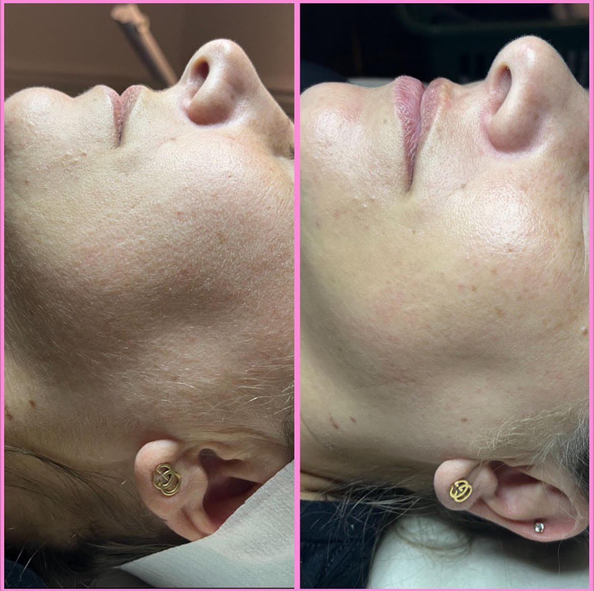 facial treatment before_after in-murrells-inlet-sc