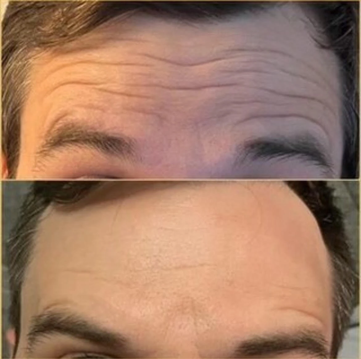 Forehead Before After in Murrells Inlet, SC | Posh Aesthetics