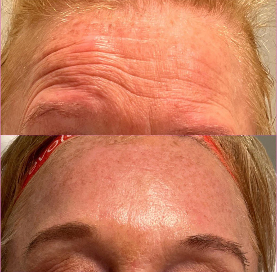 Forehead Before After1 in Murrells Inlet, SC | Posh Aesthetics