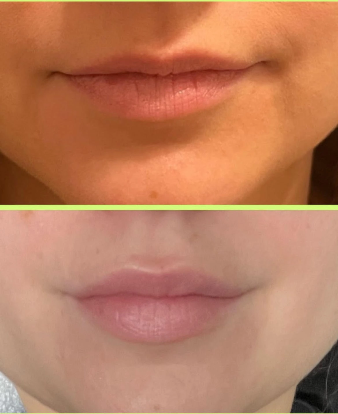 Lip Flip Before After in Murrells Inlet, SC | Posh Aesthetics