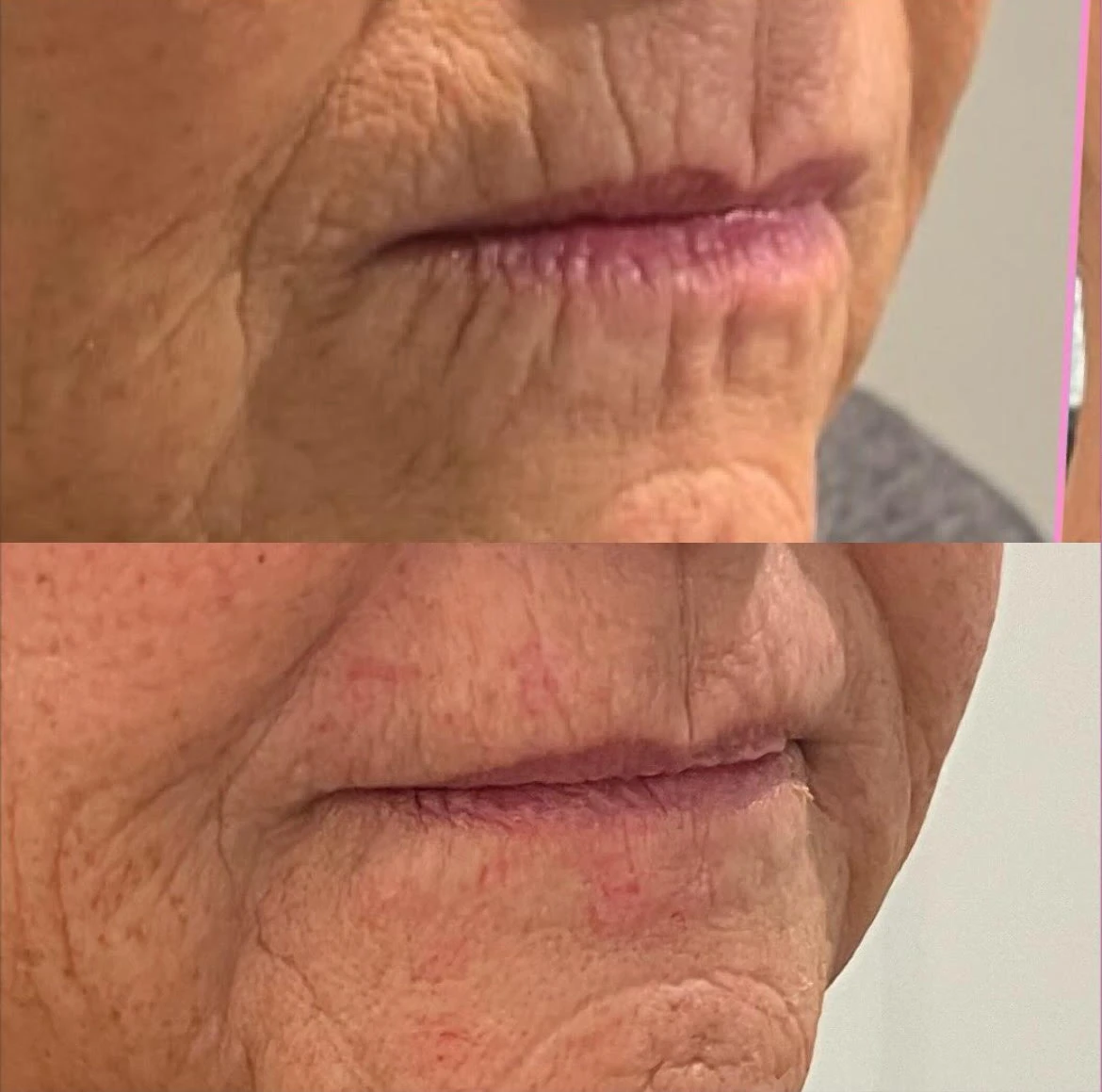 Lip Lines Before After in Murrells Inlet, SC | Posh Aesthetics