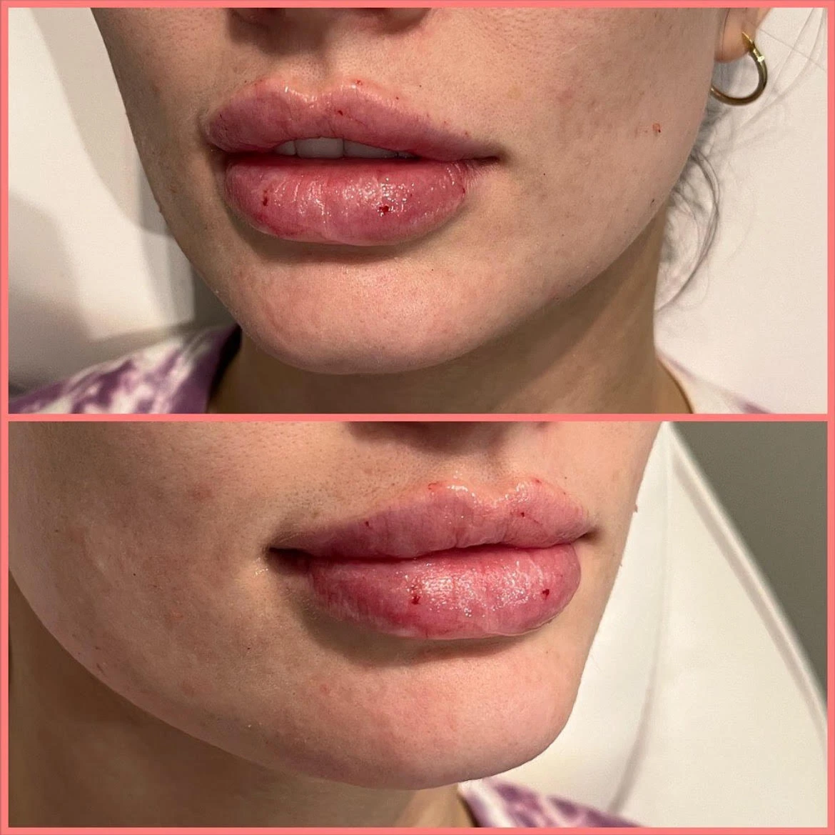 Lips Before After in Murrells Inlet, SC | Posh Aesthetics