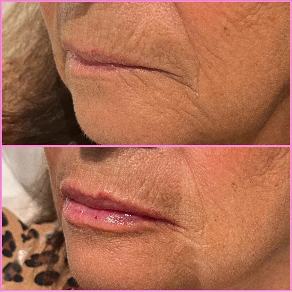 Lips Before After in Murrells Inlet, SC | Posh Aesthetics