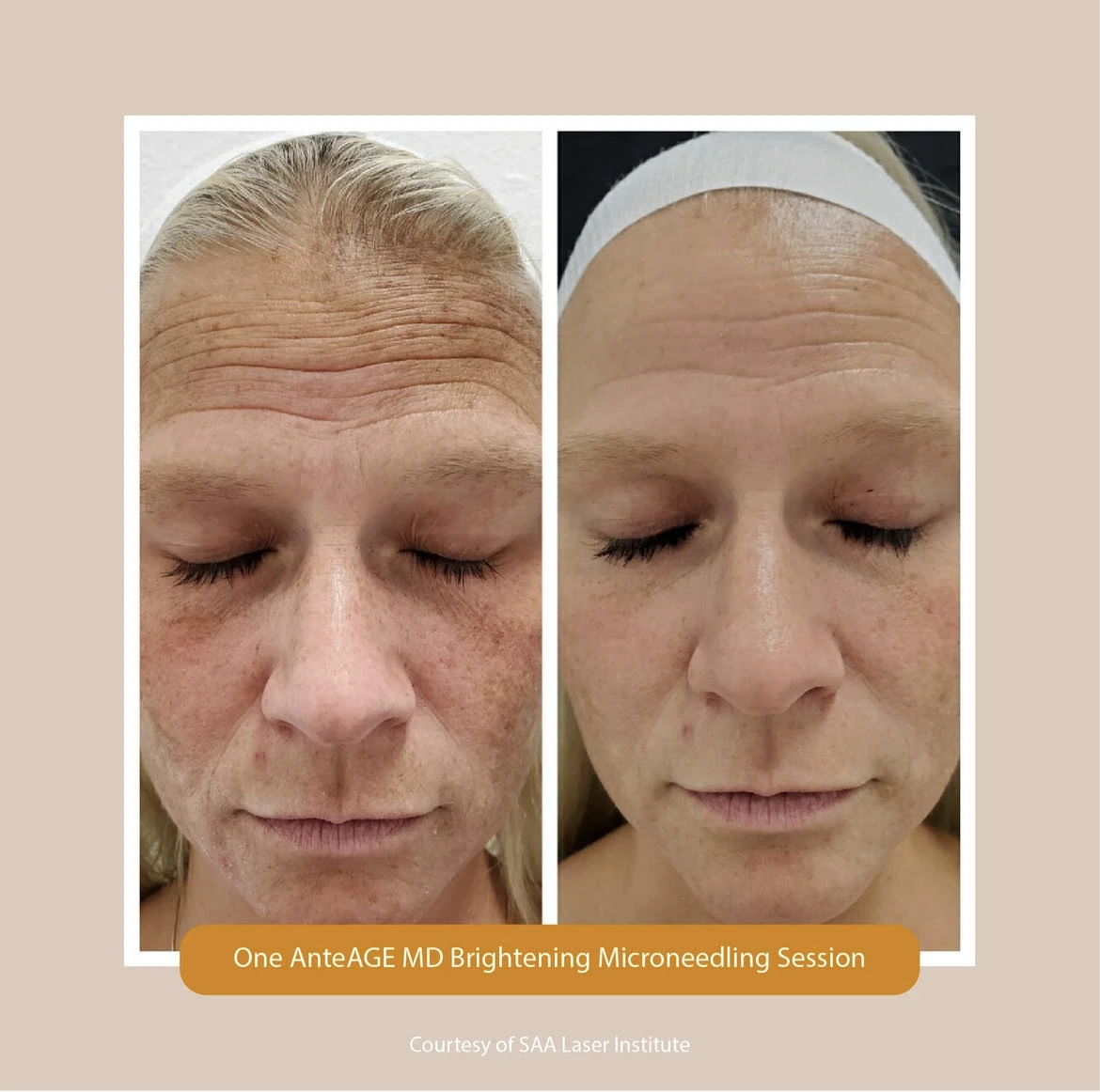 Microneedling Treatment Before After in Murrells Inlet, SC | Posh Aesthetics