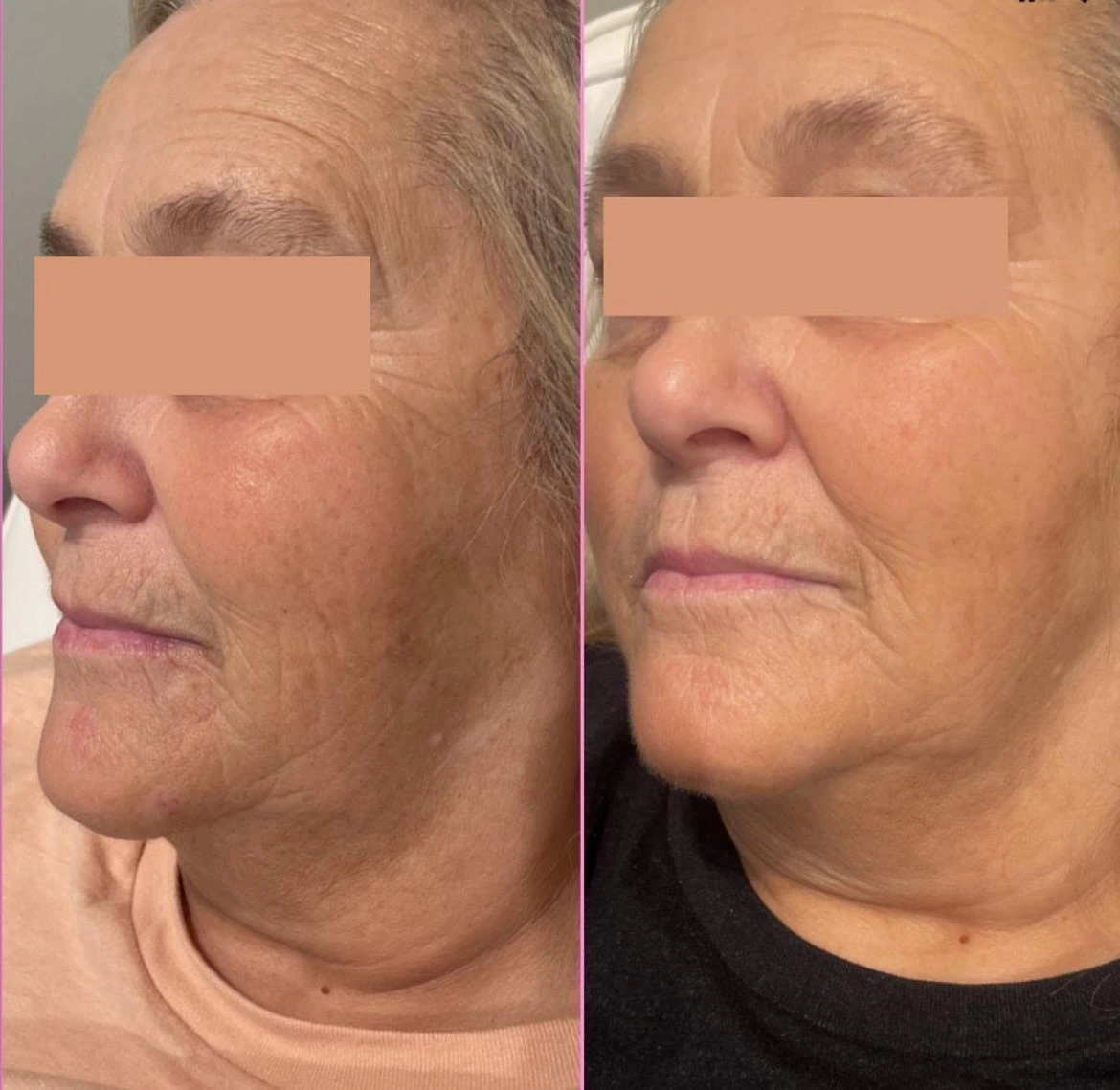 Microneedling Treatment Before After1 in Murrells Inlet, SC | Posh Aesthetics