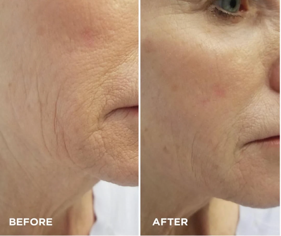 Microneedling Treatment Before After3 in Murrells Inlet, SC | Posh Aesthetics