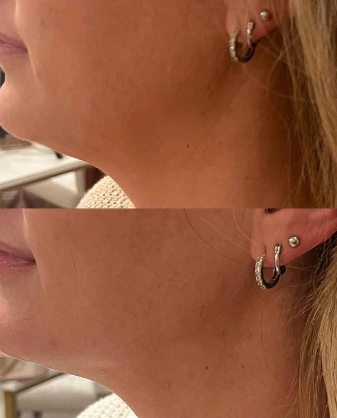 Nefertiti Lift Before After in Murrells Inlet, SC | Posh Aesthetics