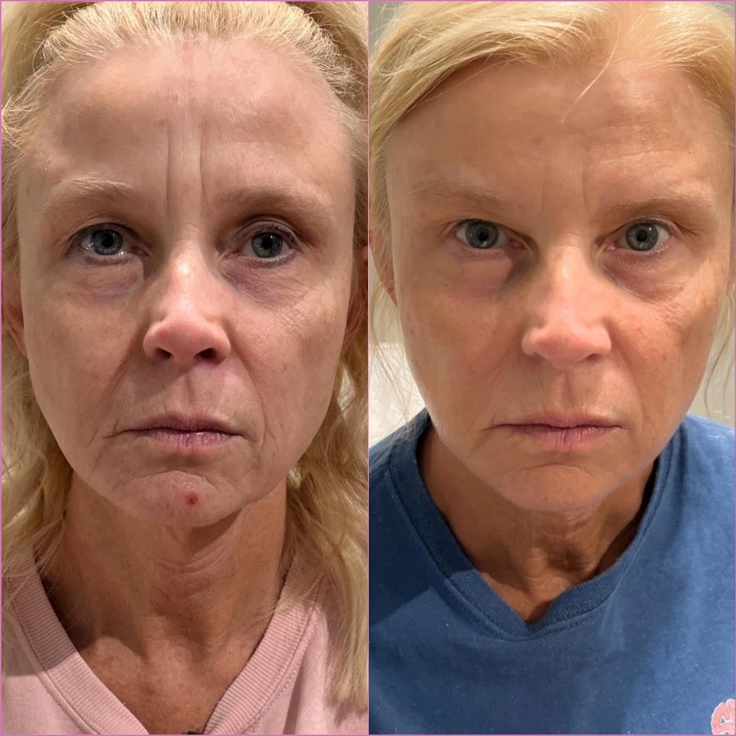 sculptra before after in-murrells-inlet-sc