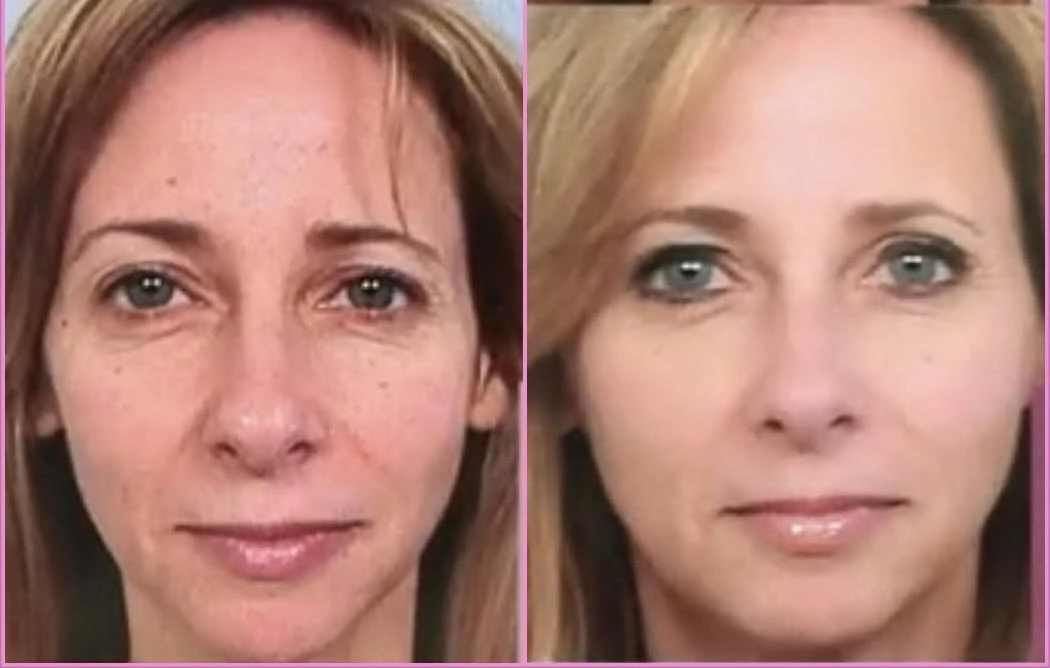 sculptra before after treatment in-murrells-inlet-sc