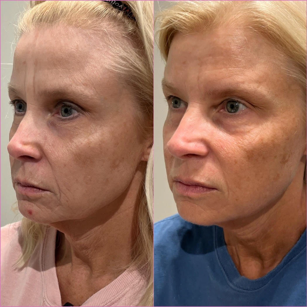 sculptra before and after in-murrells-inlet-sc