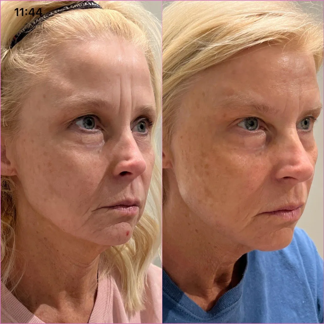 sculptra before or after in-murrells-inlet-sc