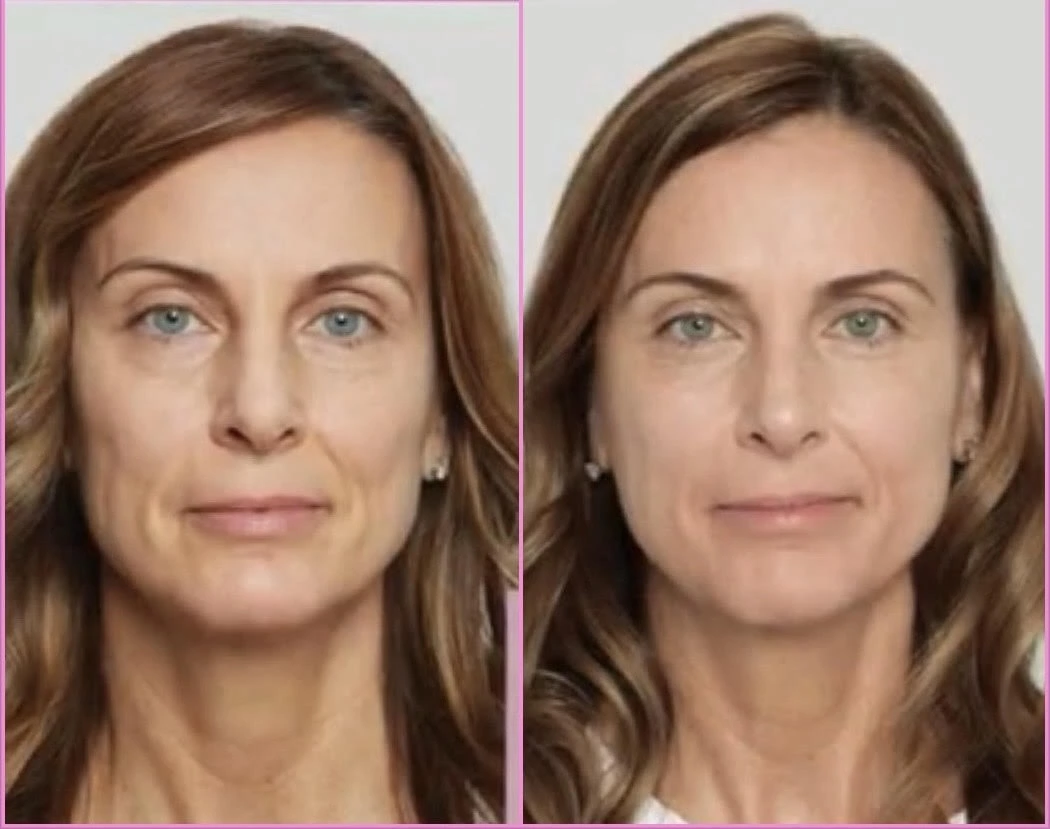 sculptra before treatment and after treatment in-murrells-inlet-sc