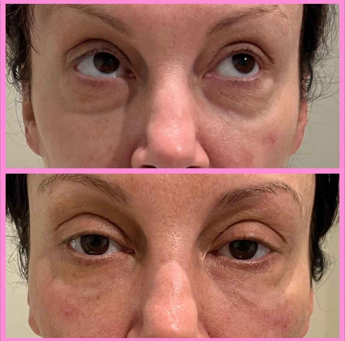 Under Eyes Before After in Murrells Inlet, SC | Posh Aesthetics